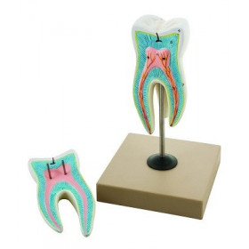 Molar de raiz triple superior con caries, ampliado 15 veces, 2 partes