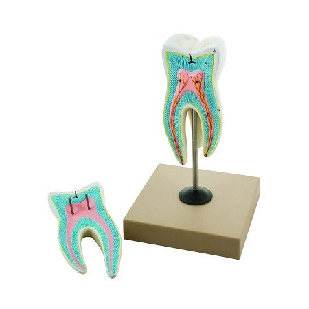 Molar de raiz triple superior con caries, ampliado 15 veces, 2 partes
